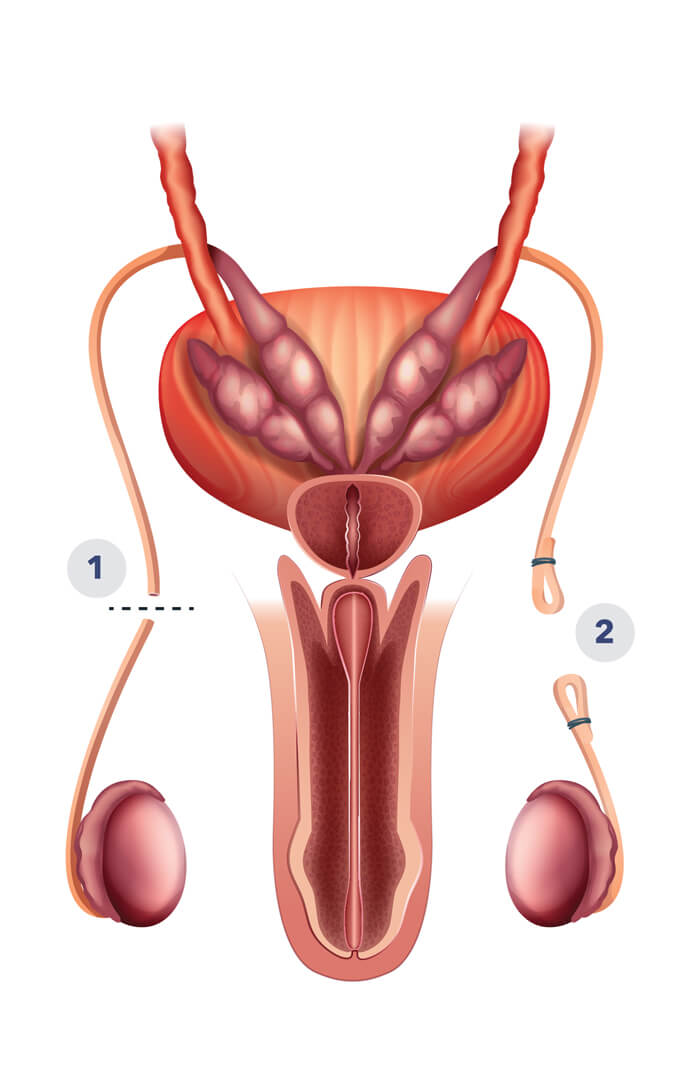 Vasectomy illustration